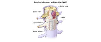 Carotid Stenting